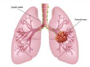 Lung Cancer Tumoral Mass Lymph Nodes